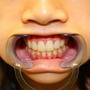 The same patient's smile after treatment at Annandale Dental Care