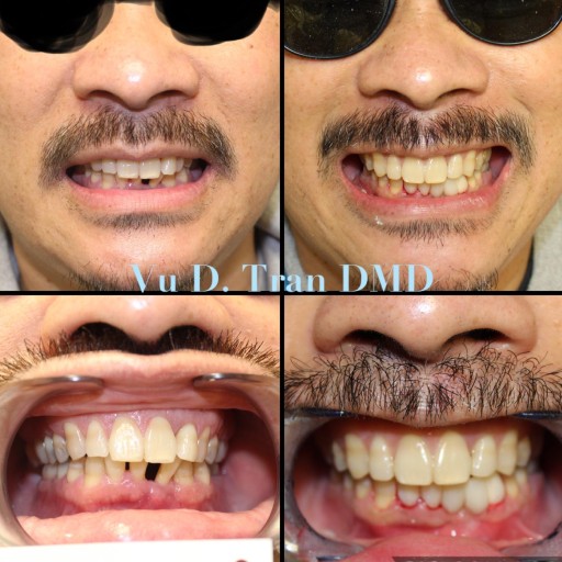 Smile makeover before and after, case three, at Annandale Dental Care