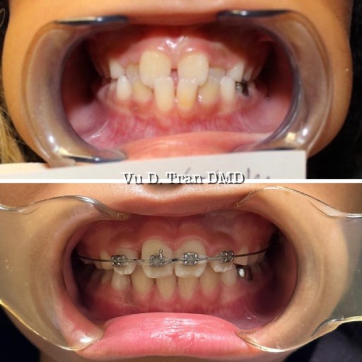 Smile makeover before and after, case four, at Annandale Dental Care