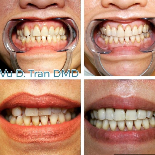 Smile makeover before and after, case five, at Annandale Dental Care