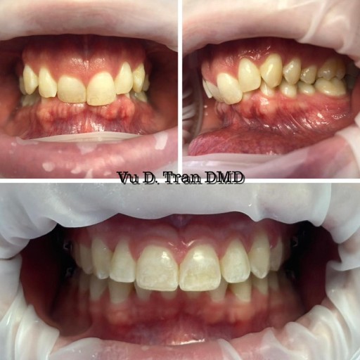 Smile makeover before and after, case six, at Annandale Dental Care